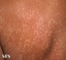 pityriasis versicolor