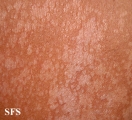 pityriasis versicolor