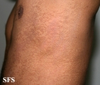 pityriasis versicolor