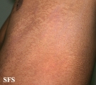 pityriasis versicolor