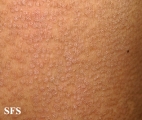 pityriasis versicolor