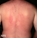 pityriasis versicolor