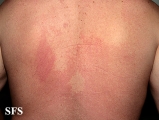 pityriasis versicolor
