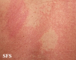 pityriasis versicolor