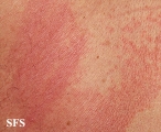 pityriasis versicolor
