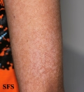 pityriasis versicolor