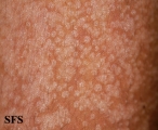 pityriasis versicolor