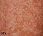 pityriasis versicolor