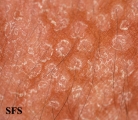 pityriasis versicolor