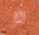 pityriasis versicolor