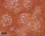pityriasis versicolor