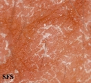 pityriasis versicolor
