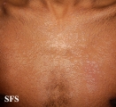 pityriasis versicolor