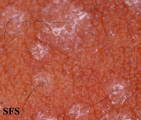 pityriasis versicolor