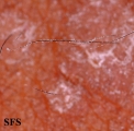 pityriasis versicolor