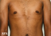 pityriasis versicolor