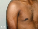 pityriasis versicolor