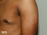 pityriasis versicolor