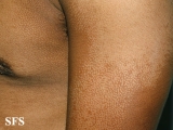 pityriasis versicolor