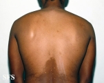 pityriasis versicolor