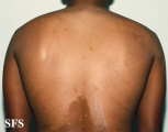 pityriasis versicolor