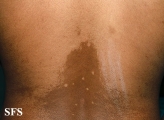 pityriasis versicolor