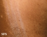 pityriasis versicolor