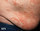 pityriasis versicolor