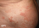pityriasis versicolor