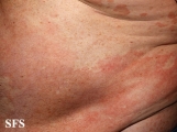 pityriasis versicolor
