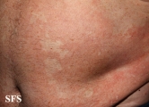 pityriasis versicolor