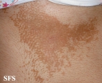 pityriasis versicolor
