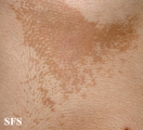 pityriasis versicolor