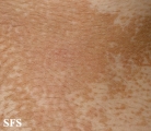 pityriasis versicolor