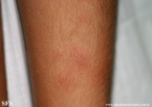 erythema nodosum
