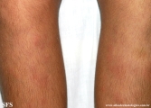 erythema nodosum