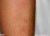erythema nodosum