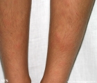 erythema nodosum