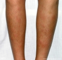 erythema nodosum