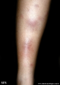 erythema nodosum
