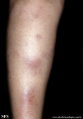 erythema nodosum