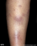 erythema nodosum