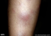 erythema nodosum