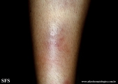 erythema nodosum