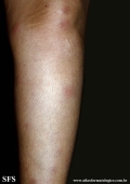 erythema nodosum