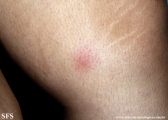 erythema nodosum