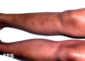 erythema nodosum