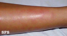 erythema nodosum