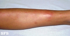 erythema nodosum