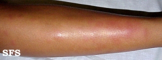 erythema nodosum